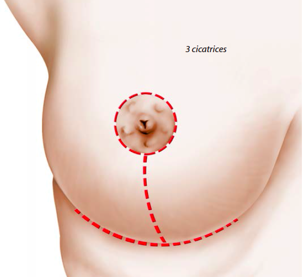 dessin plastie mammaire de reduction