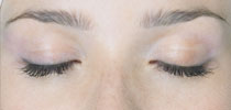 blepharoplasties