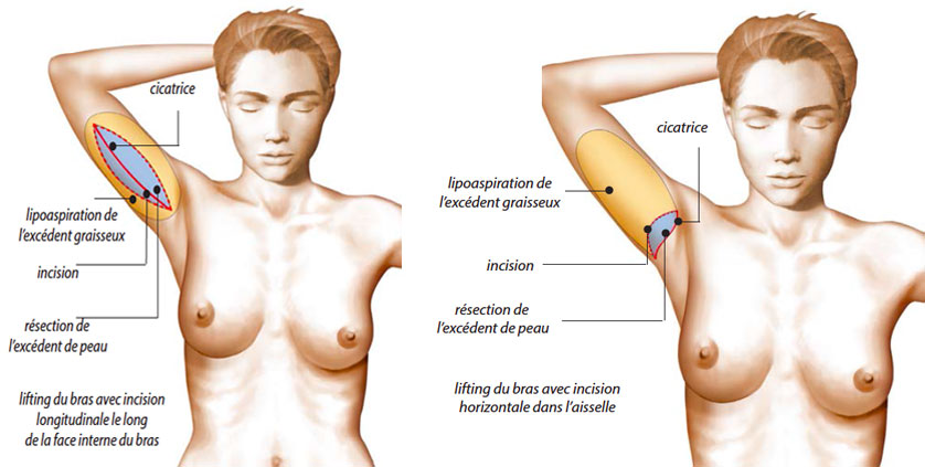 Brachioplastie