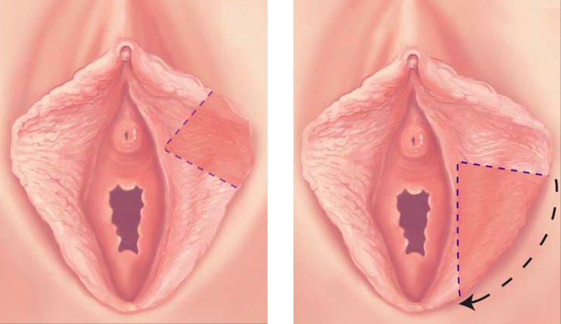 Nymphoplastie de réduction – Docteur Adjadj